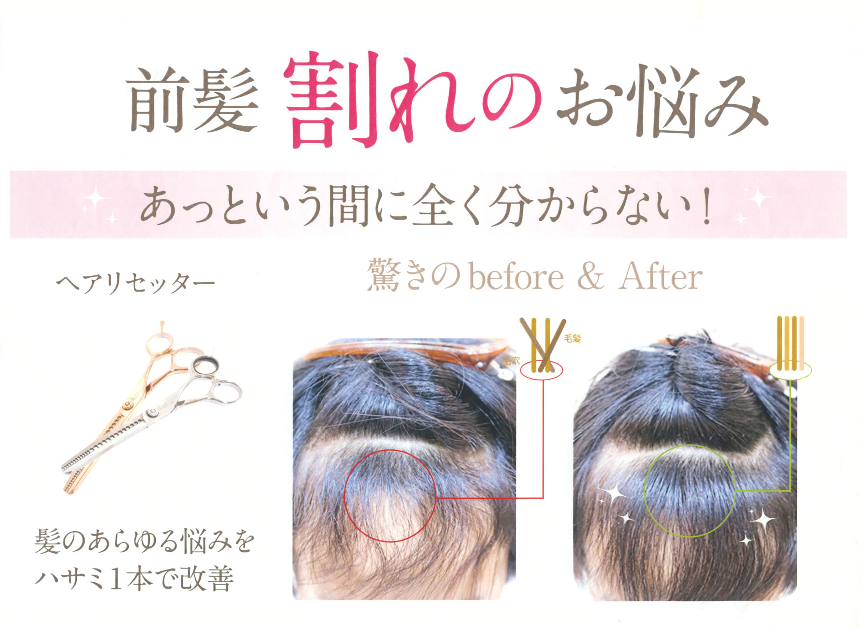 前髪割れのお悩みとヘアリセッターの施術前後を紹介する公式画像